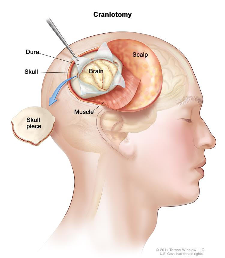 Craniotomy: Surgery to remove the tumor through an opening made in the skull