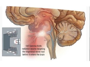 Gamma Knife Radiation