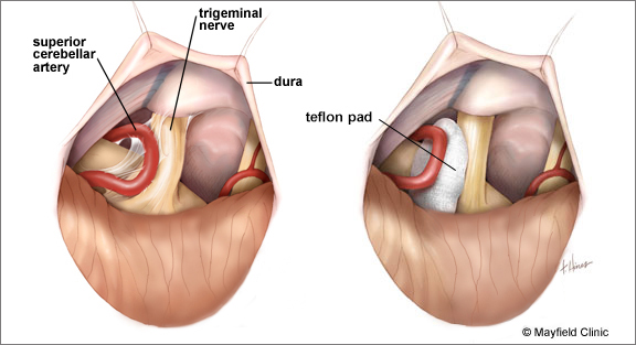 MVD vascular compression