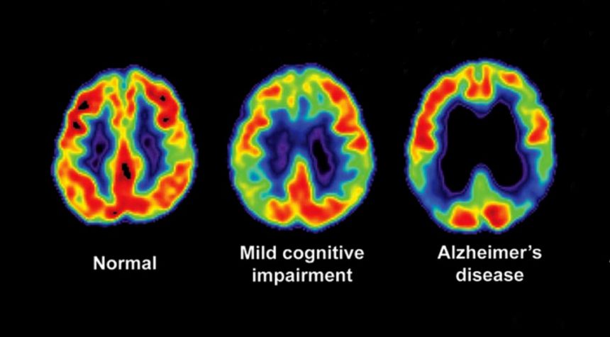 Amyloid PET Scan for Diagnosis of Cognitive Impairment and Dementia