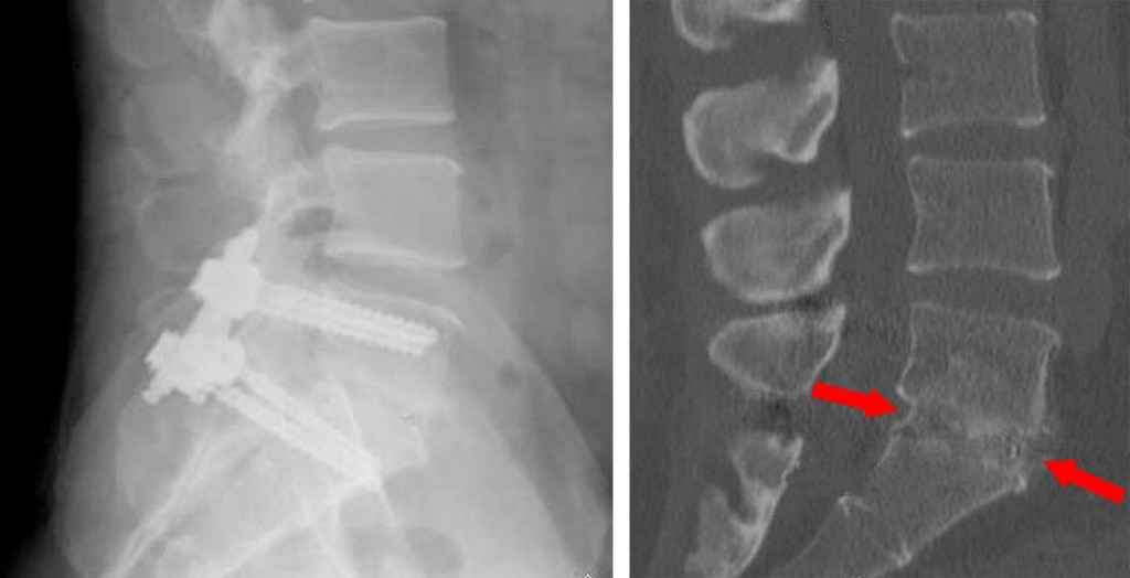 SPINAL FUSION